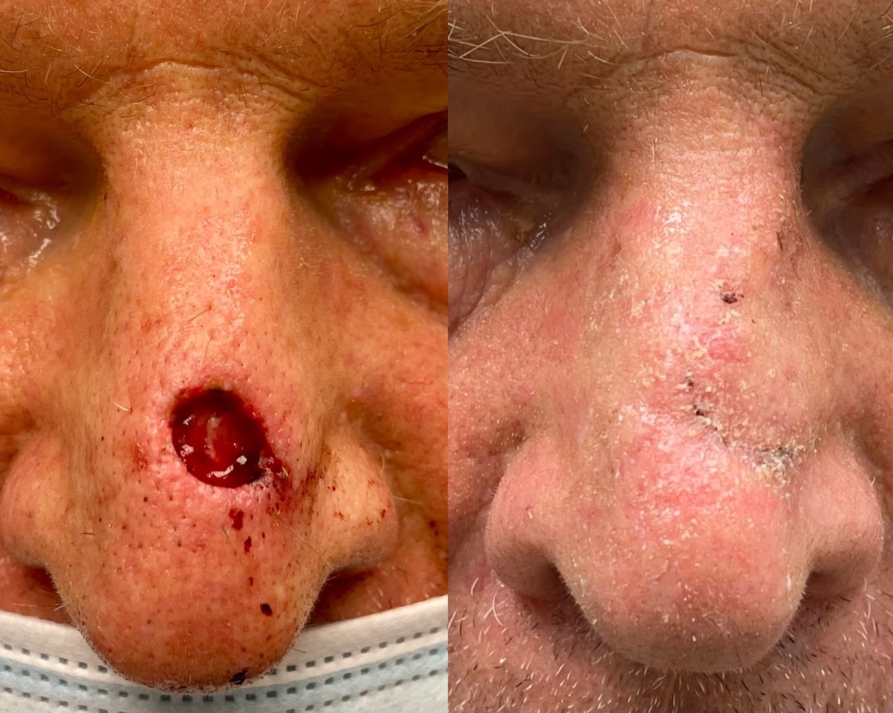MOHS skin cancer surgery