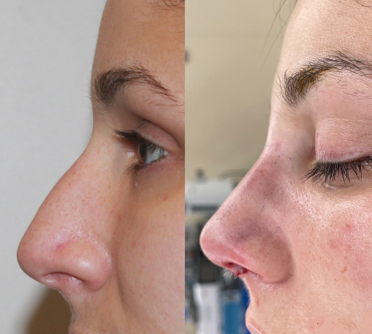 RHINOPLASTY