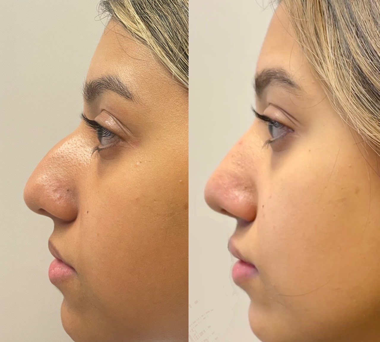 RHINOPLASTY